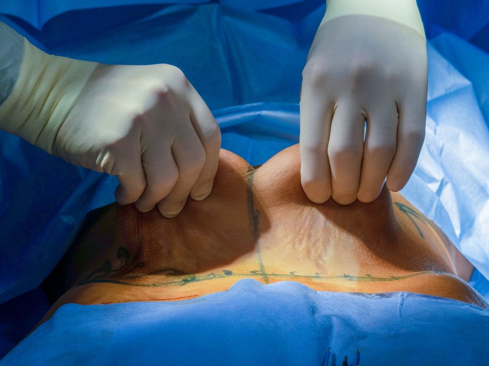 Abdominoplastia remove o excesso de pele e gordura na barriga.