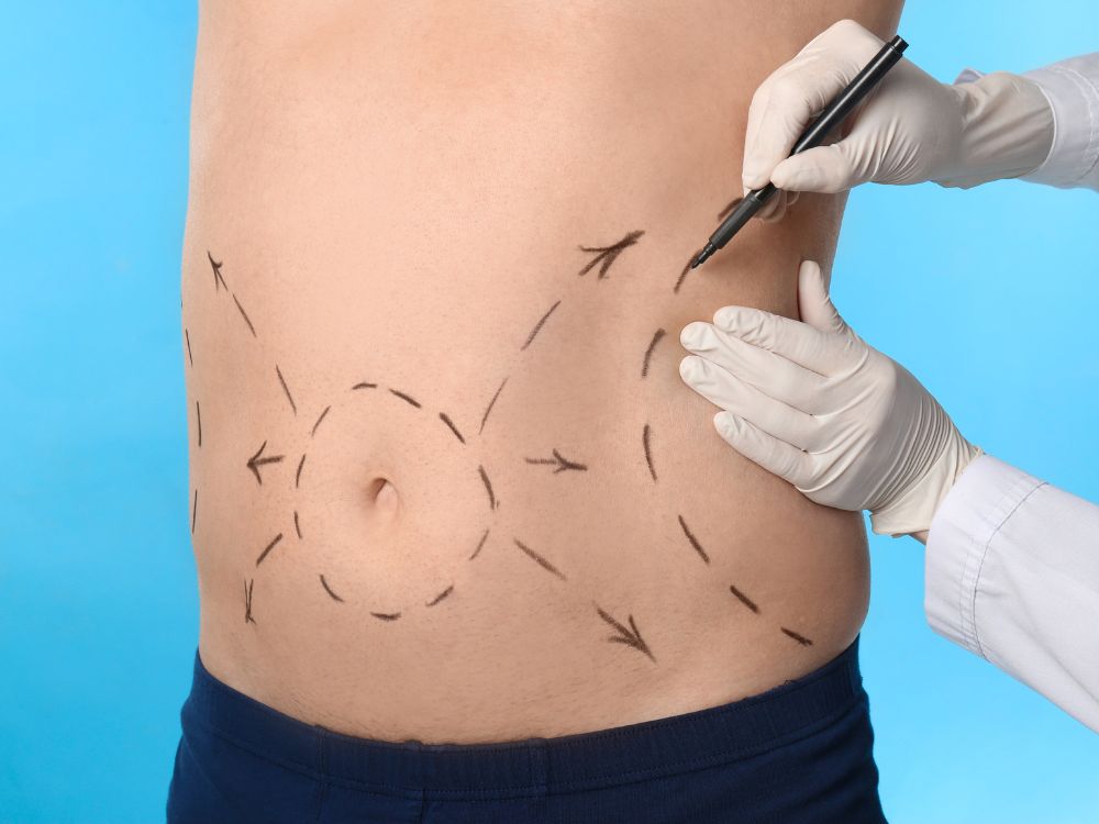 Pós-operatório abdominoplastia exige cuidados
