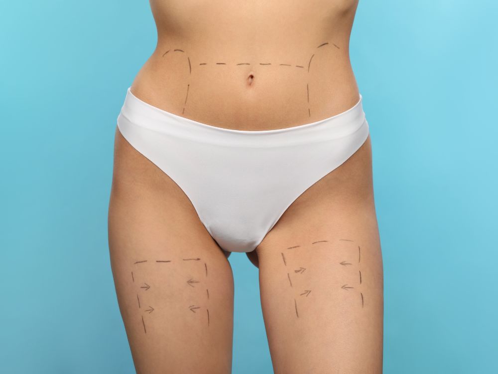 Pós-operatório abdominoplastia pode ser tranquilo