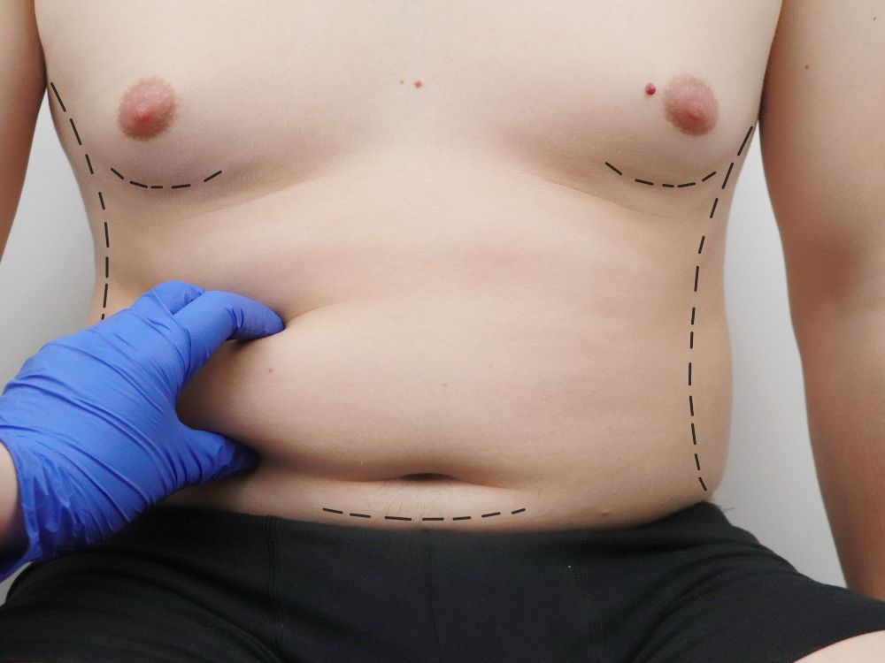 Pós-operatório abdominoplastia requer repouso