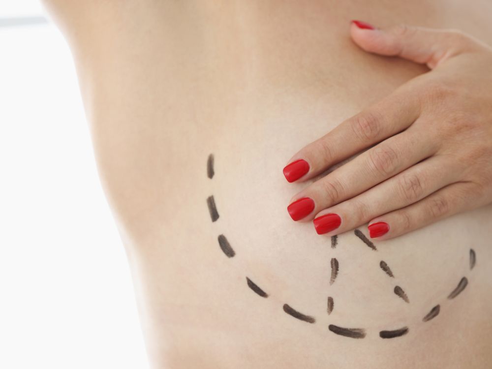 Seio com marcações cirúrgicas para mamoplastia redutora. Leia sobre mamoplastia redutora risco de morte e os cuidados essenciais.