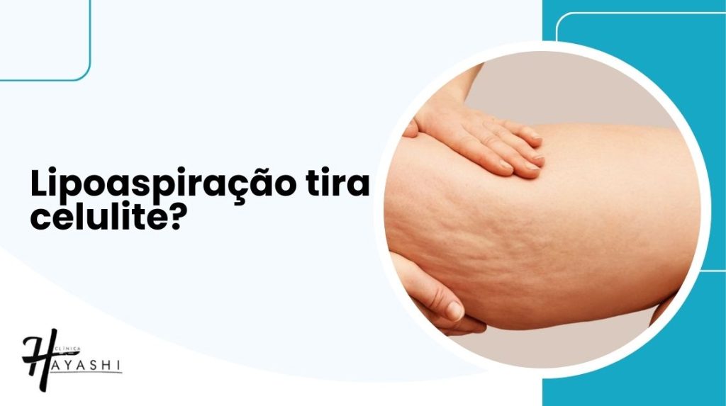 Imagem com a pergunta "Lipoaspiração tira celulite?" ao lado de uma coxa com celulite visível. A Clínica Hayashi explica a relação entre lipoaspiração e celulite.