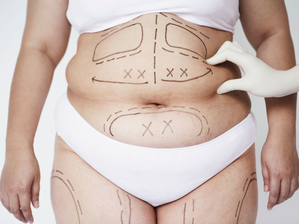 Corpo feminino com marcações cirúrgicas: Lipoaspiração emagrece em aparência e melhora a silhueta ao eliminar gordura resistente.