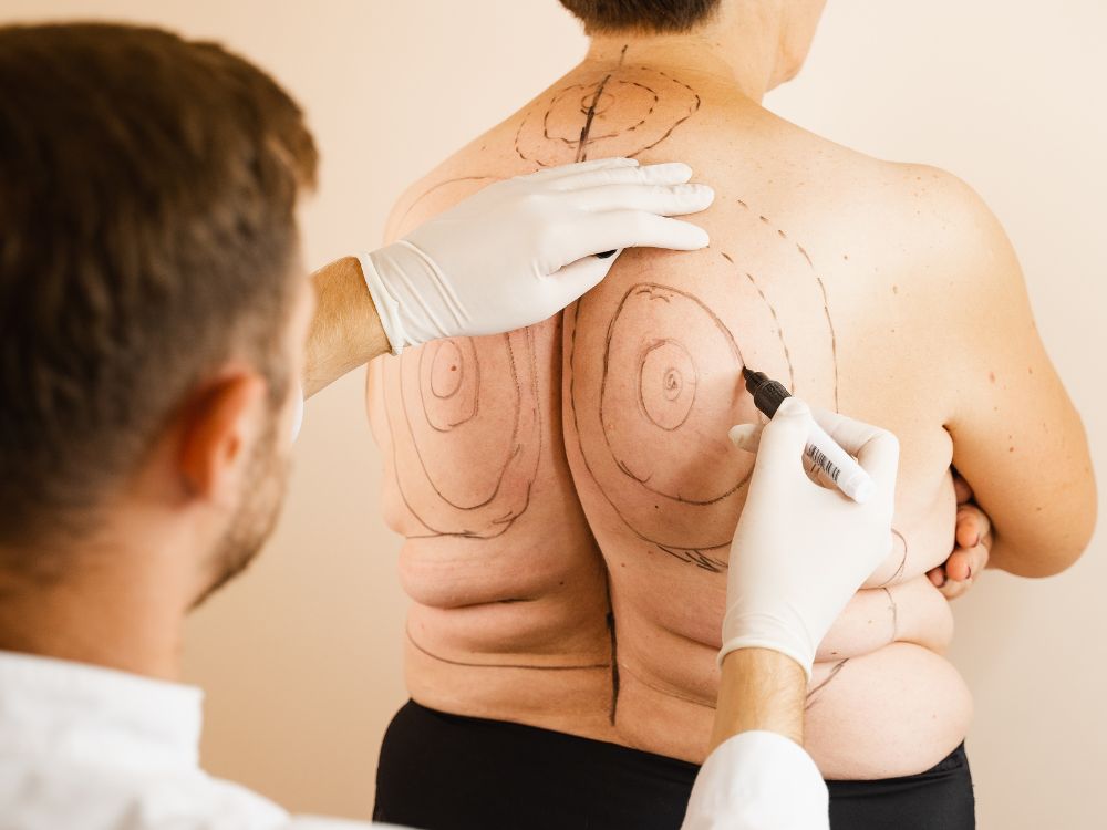 Médico marcando costas para cirurgia: Lipoaspiração emagrece ao remover gordura localizada, mas não substitui hábitos saudáveis.