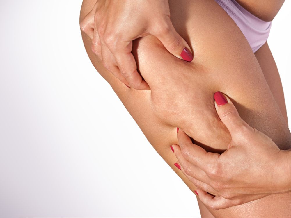 Mulher apertando a pele da coxa para mostrar celulite. Muitas pessoas se perguntam se a lipoaspiração tira celulite e melhora a aparência da pele.