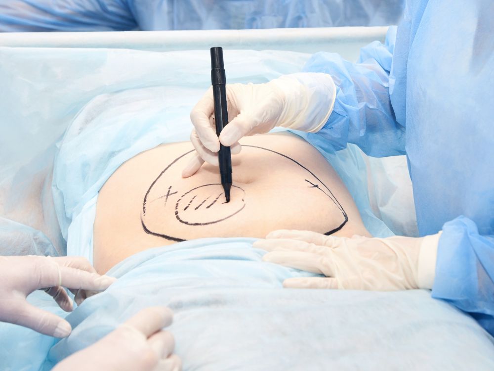Abdômen sendo marcado antes de cirurgia: Lipoaspiração emagrece no contorno corporal e ajuda a definir áreas com excesso de gordura.