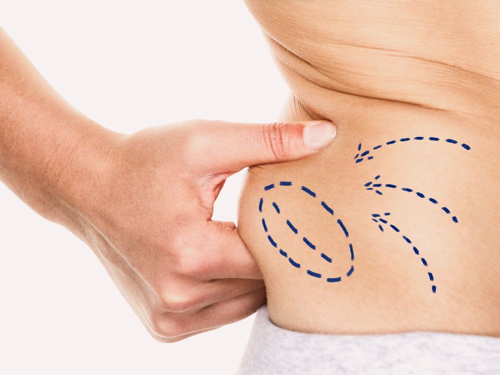 Mão segurando gordura abdominal com setas desenhadas. Visualização da região abdominal com gordura localizada, ideal para tratamentos como a Lipo Ultra HD UGraft voltada à definição muscular