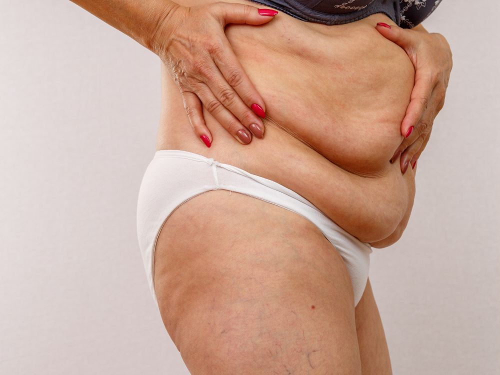 Pessoa com excesso de pele abdominal após perda de peso. Ilustração sobre com quantos anos pode fazer lipoaspiração.