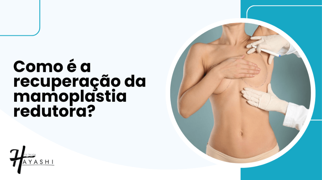 Banner da Clínica Hayashi com a pergunta 'Como é a recuperação da mamoplastia redutora?' ao lado de imagem de paciente com marcações cirúrgicas nos seios.