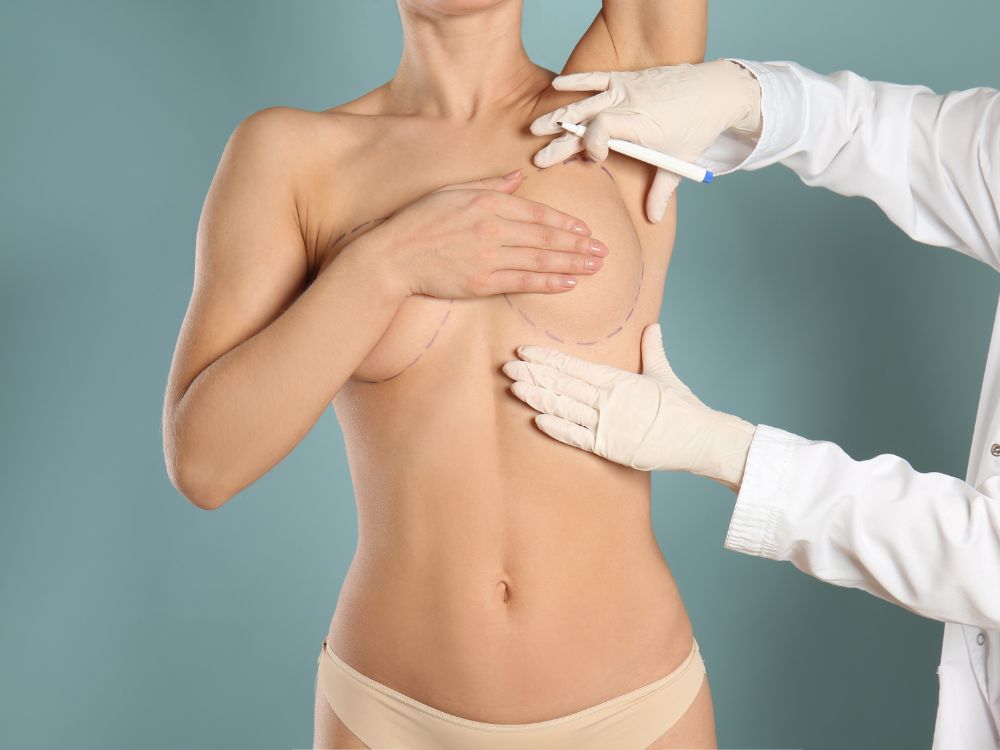Médico realizando marcações pré-operatórias em mulher com hipertrofia mamária, etapa inicial da recuperação mamoplastia redutora.