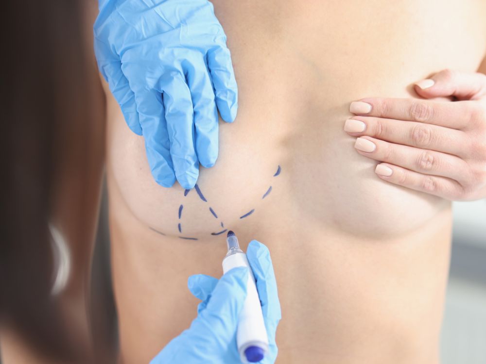 Marcação cirúrgica em mama feminina feita por profissional com luvas azuis, representando o planejamento da recuperação mamoplastia redutora.
