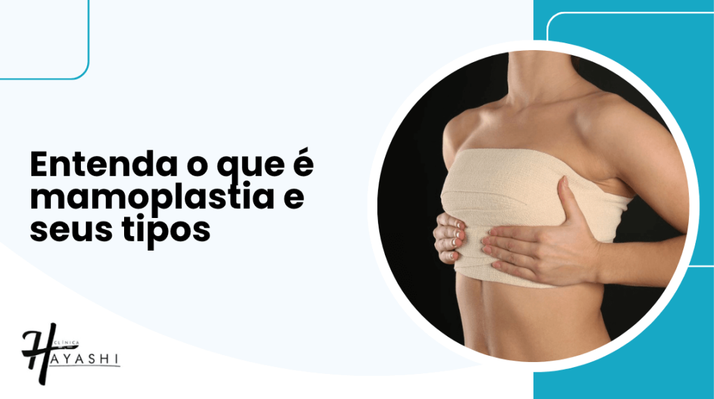 Imagem ilustrativa com frase "Entenda o que é mamoplastia e seus tipos" ao lado de mulher com faixa de compressão no tórax após cirurgia de mama.