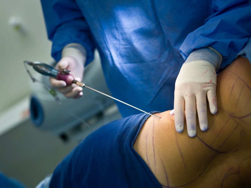 Procedimento médico com cânula para aspiração de gordura corporal, representando o que é lipoenxertia na etapa de coleta.