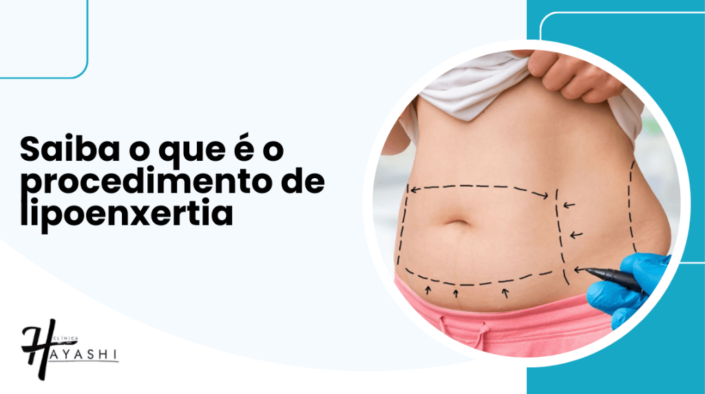 Banner com o título “Saiba o que é o procedimento de lipoenxertia” e imagem de abdômen com marcações cirúrgicas para retirada de gordura.