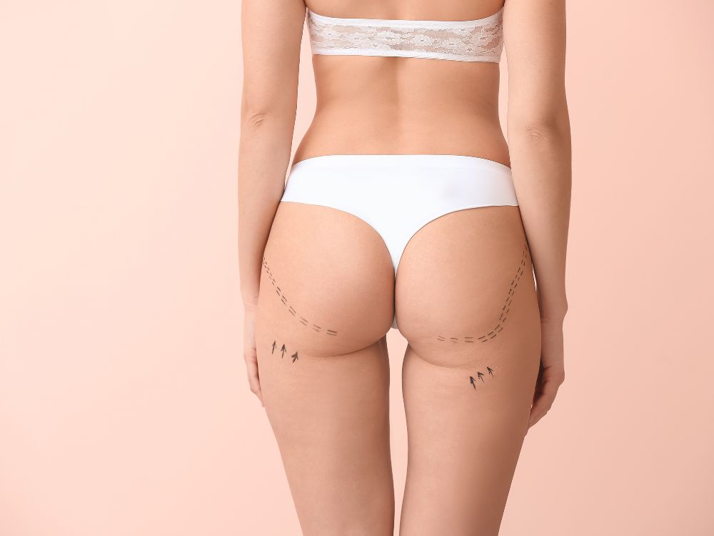 Vista posterior com marcações estéticas nos glúteos, demonstrando o que é lipoenxertia para remodelação corporal.