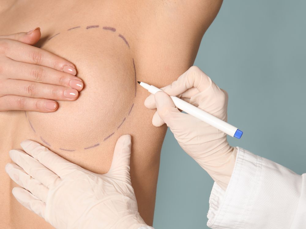 Marcação cirúrgica na mama sendo realizada por profissional de saúde, representando quanto tempo de repouso da mamoplastia e o planejamento do procedimento.