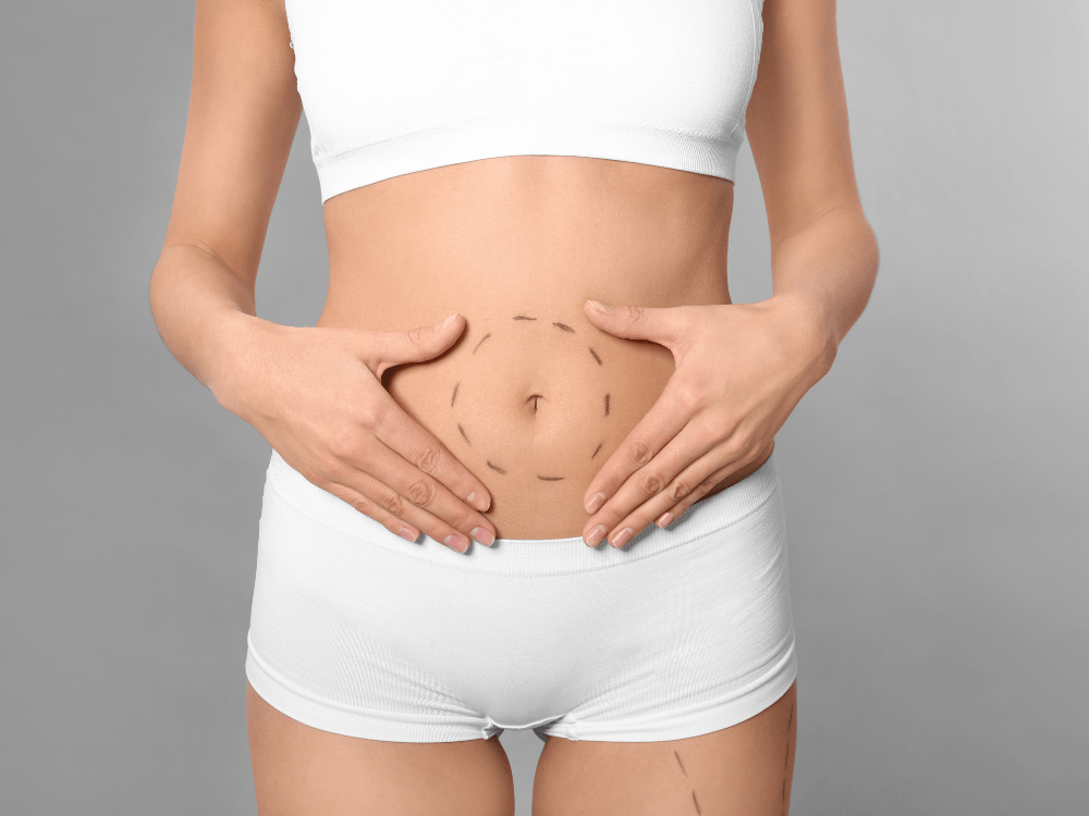 Mulher com marcações na região abdominal segurando a barriga, representando cuidados após a abdominoplastia.