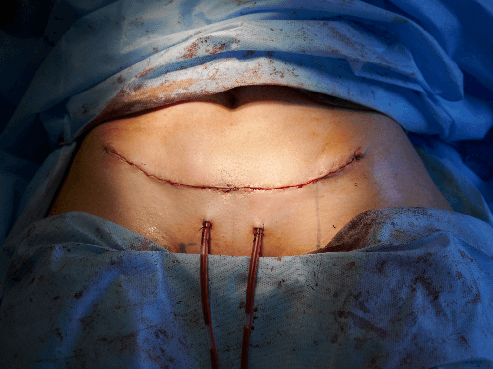 Abdômen recém-operado com drenos e cicatriz cirúrgica, representando o controle do inchaço após abdominoplastia.