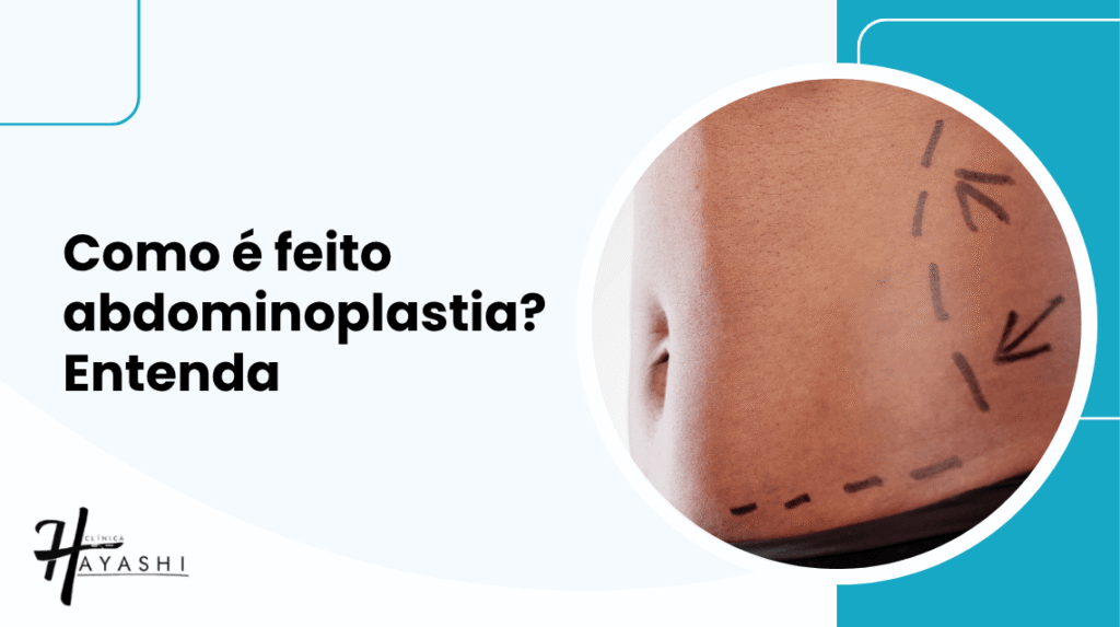 Capa do artigo sobre como é feito abdominoplastia, com imagem de abdômen marcado para cirurgia e título em destaque.