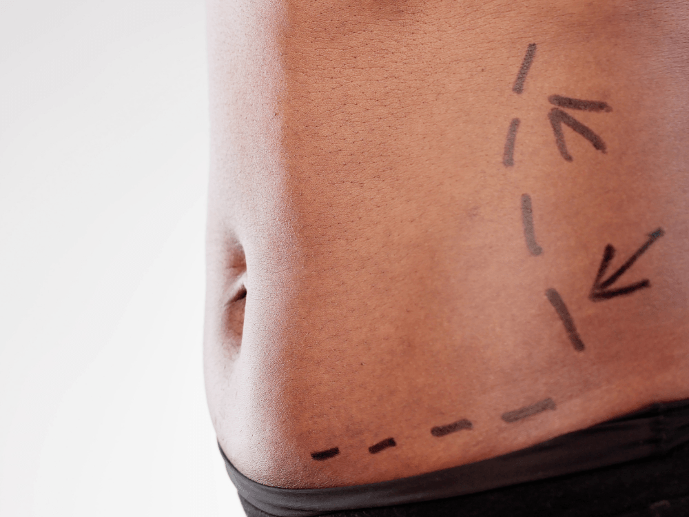Abdômen com marcações cirúrgicas feitas antes da abdominoplastia para orientar a remoção do excesso de pele.