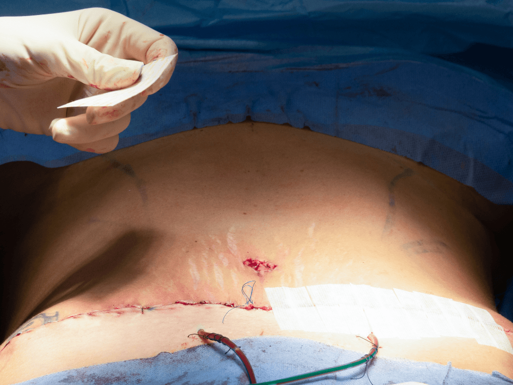 Região abdominal logo após cirurgia com incisão suturada e curativo, ilustrando o pós-operatório da abdominoplastia.
