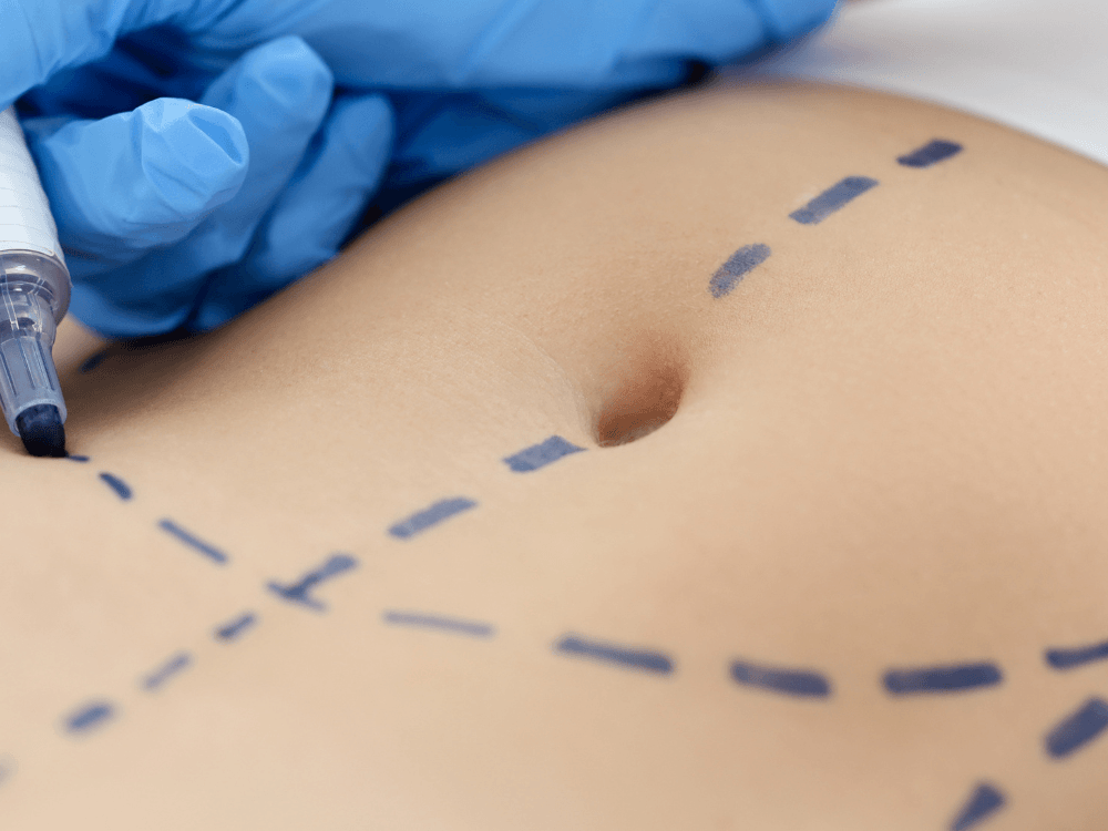 Abdômen com marcações realizadas antes da cirurgia, etapa utilizada no planejamento do procedimento, para explicar como fica a barriga depois da abdominoplastia
