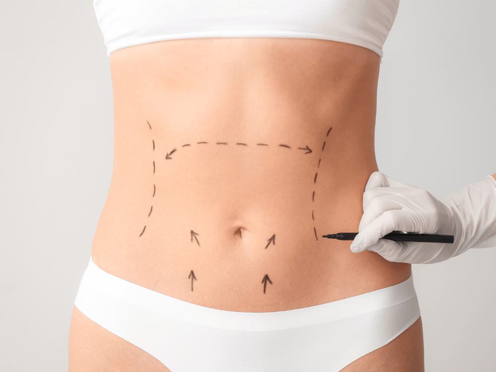 Profissional realiza marcações no abdômen antes da abdominoplastia para planejar o procedimento cirúrgico com precisão.