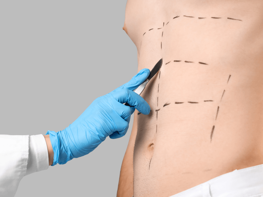Profissional de saúde marca áreas do abdômen com caneta, em uma representação visual da abdominoplastia e seu planejamento. Tudo para explicar se quem fez abdominoplastia pode fazer agachamento.