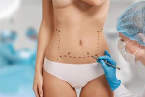 Procedimento de abdominoplastia