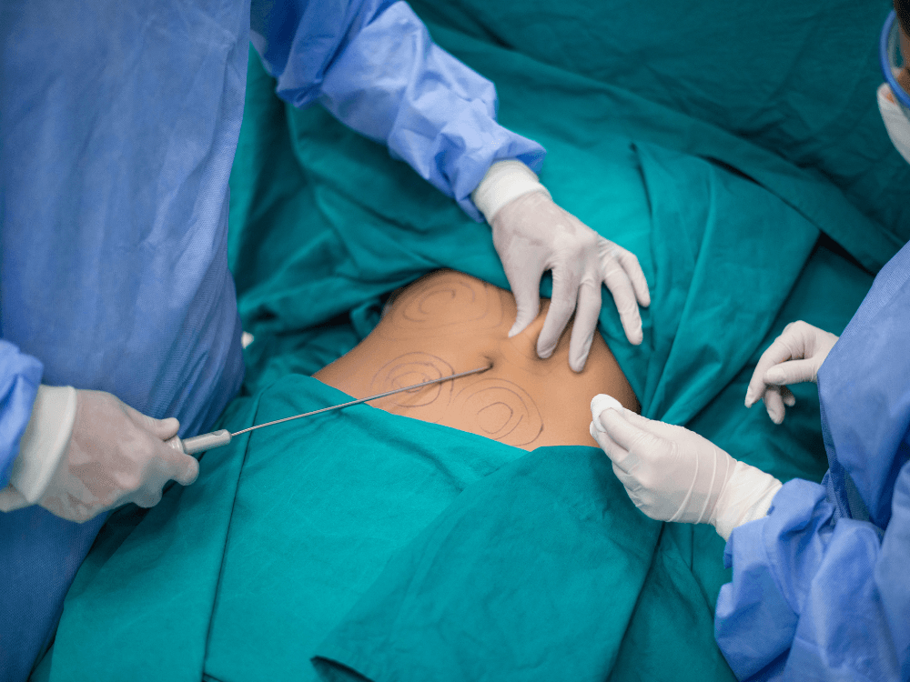 Equipe médica realiza procedimento de lipoaspiração no abdômen, com marcações corporais e instrumentos cirúrgicos.