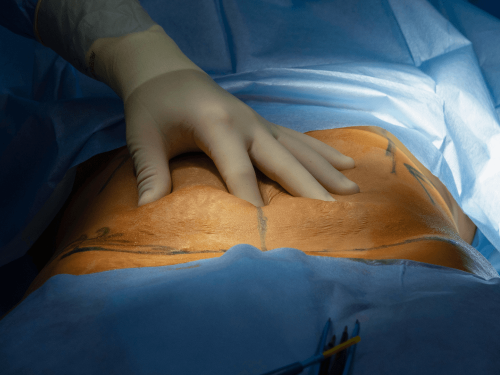 Mão enluvada examina abdômen de paciente durante cirurgia, com marcações azuis que orientam o planejamento do procedimento.