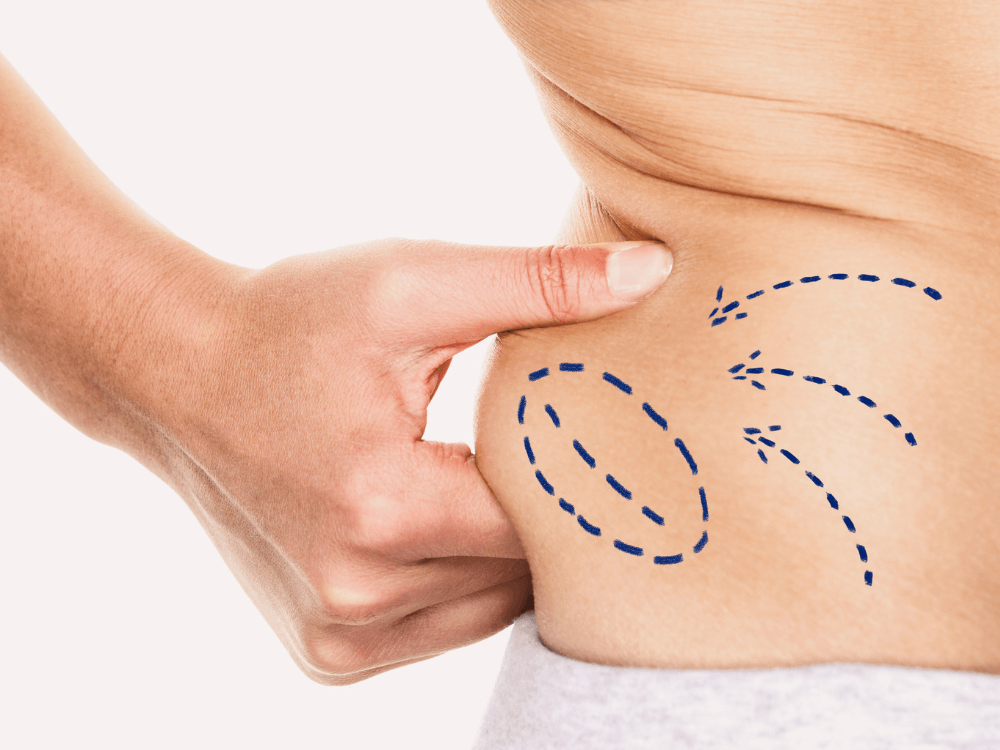 Mão pinça a pele do abdômen de uma pessoa com marcações azuis que indicam áreas de gordura para cirurgia plástica. Tudo para explicar qual a diferença entre abdominoplastia e lipoaspiração.