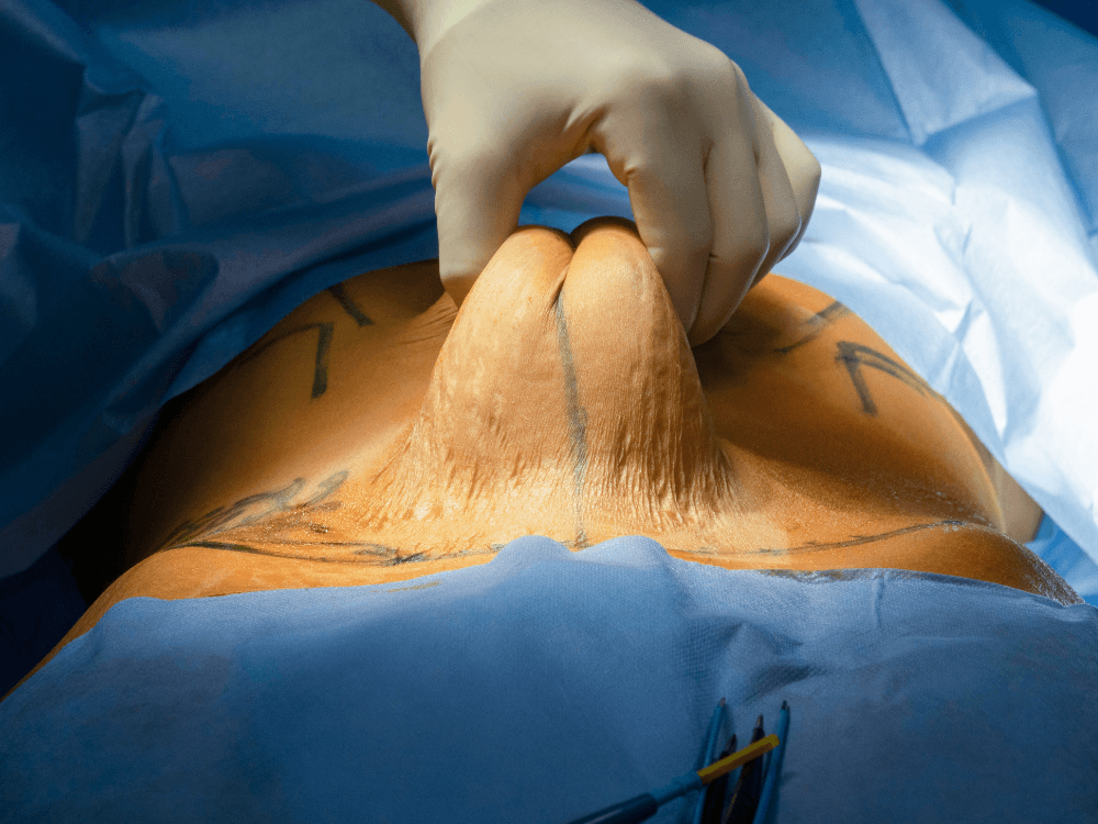 Profissional de saúde pinça a pele do abdômen de paciente preparado para cirurgia, com marcações sobre a região abdominal.