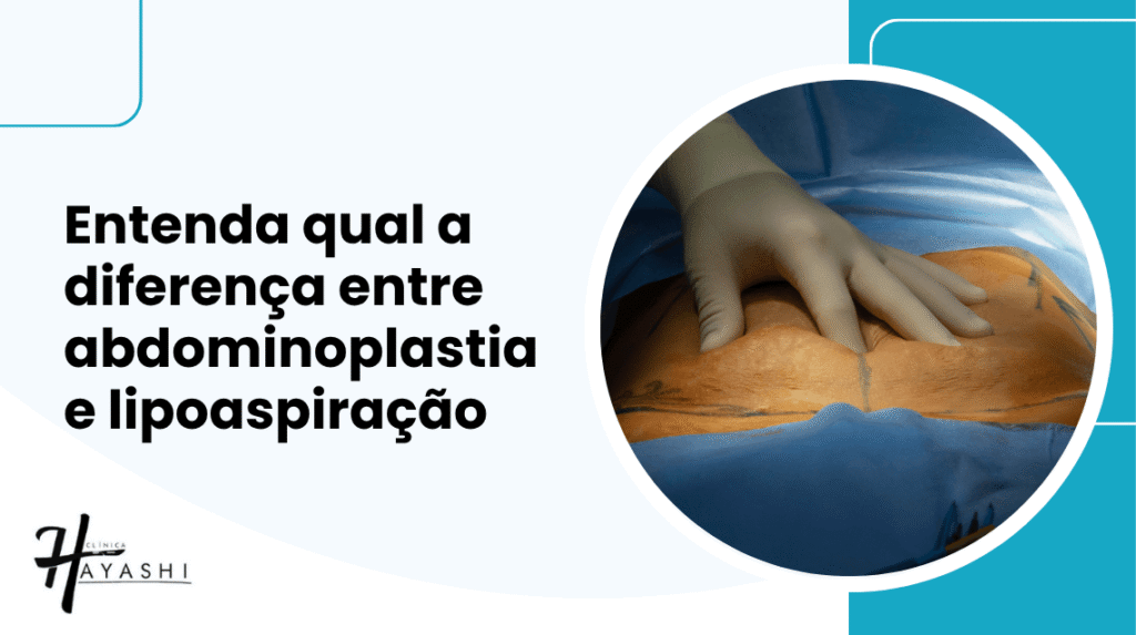 Arte com título sobre a diferença entre abdominoplastia e lipoaspiração, acompanhada de imagem de cirurgia abdominal.