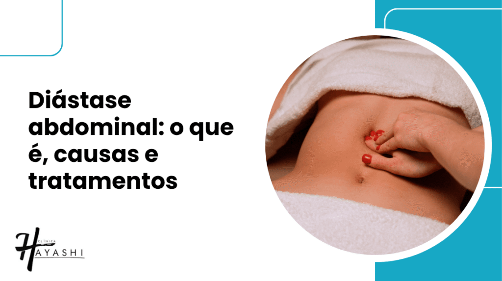 Capa do artigo sobre diástase abdominal, com uma mão tocando a região do ventre e o título sobre causas e tratamentos.