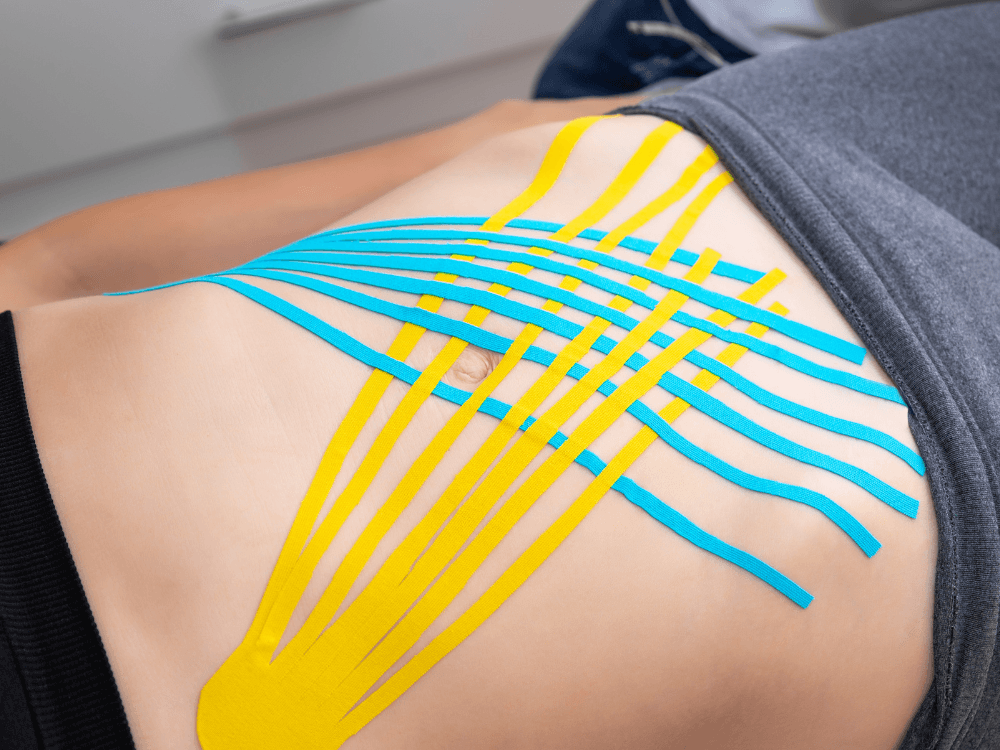 Faixas adesivas azuis e amarelas aplicadas sobre o abdômen de uma pessoa, técnica utilizada em alguns tratamentos fisioterapêuticos. Tudo para explicar diástase abdominal o que é.