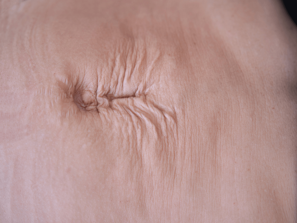 Close da região do umbigo, com pregas e linhas naturais na pele do abdômen, em uma imagem relacionada à diástase abdominal.