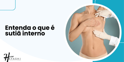 Médico realizando marcações cirúrgicas em paciente de mastopexia, ilustração explicativa sobre o que é sutiã interno.