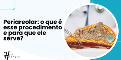 Ilustração anatômica da mama com destaque para técnica cirúrgica ao redor da aréola, explicação de Periareolar o que é.