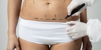 mulher-de-vista-frontal-com-tracos-de-marcador-na-pele